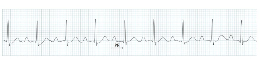 First degree AV block