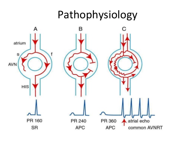 Atrioventricular nodal re-entrant tachycardia AVNRT