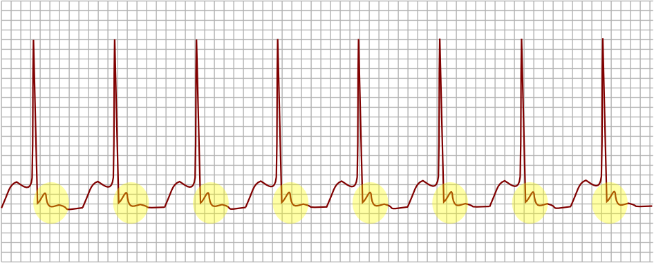 Atrioventricular nodal re-entrant tachycardia AVNRT