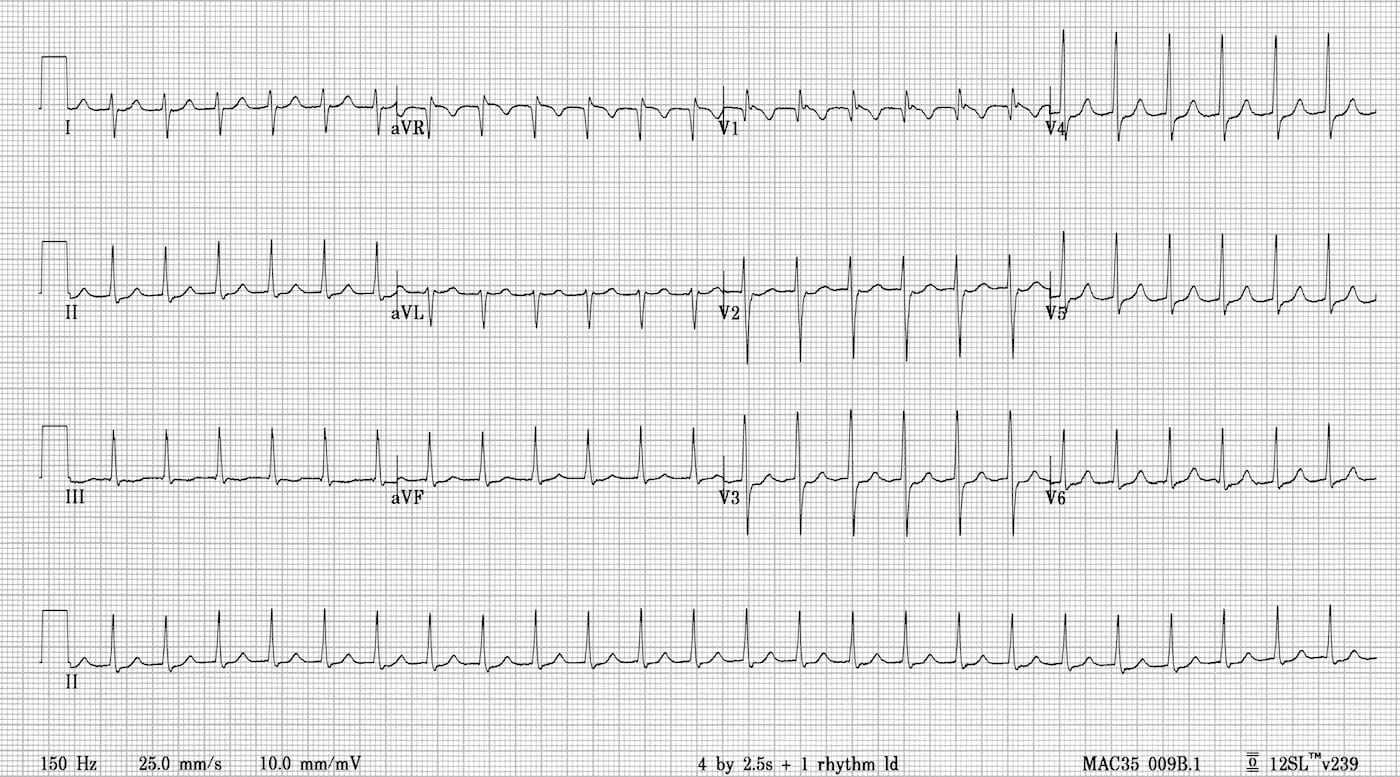 Atrioventricular nodal re-entrant tachycardia AVNRT