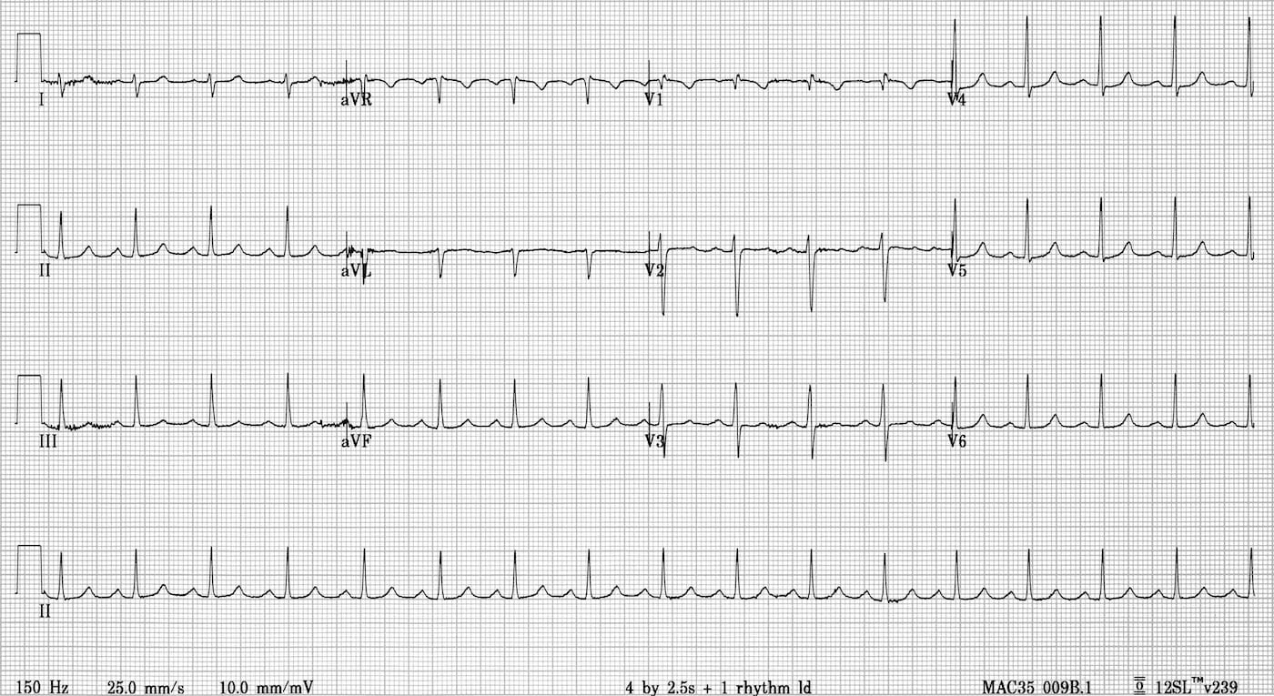 Atrioventricular nodal re-entrant tachycardia AVNRT
