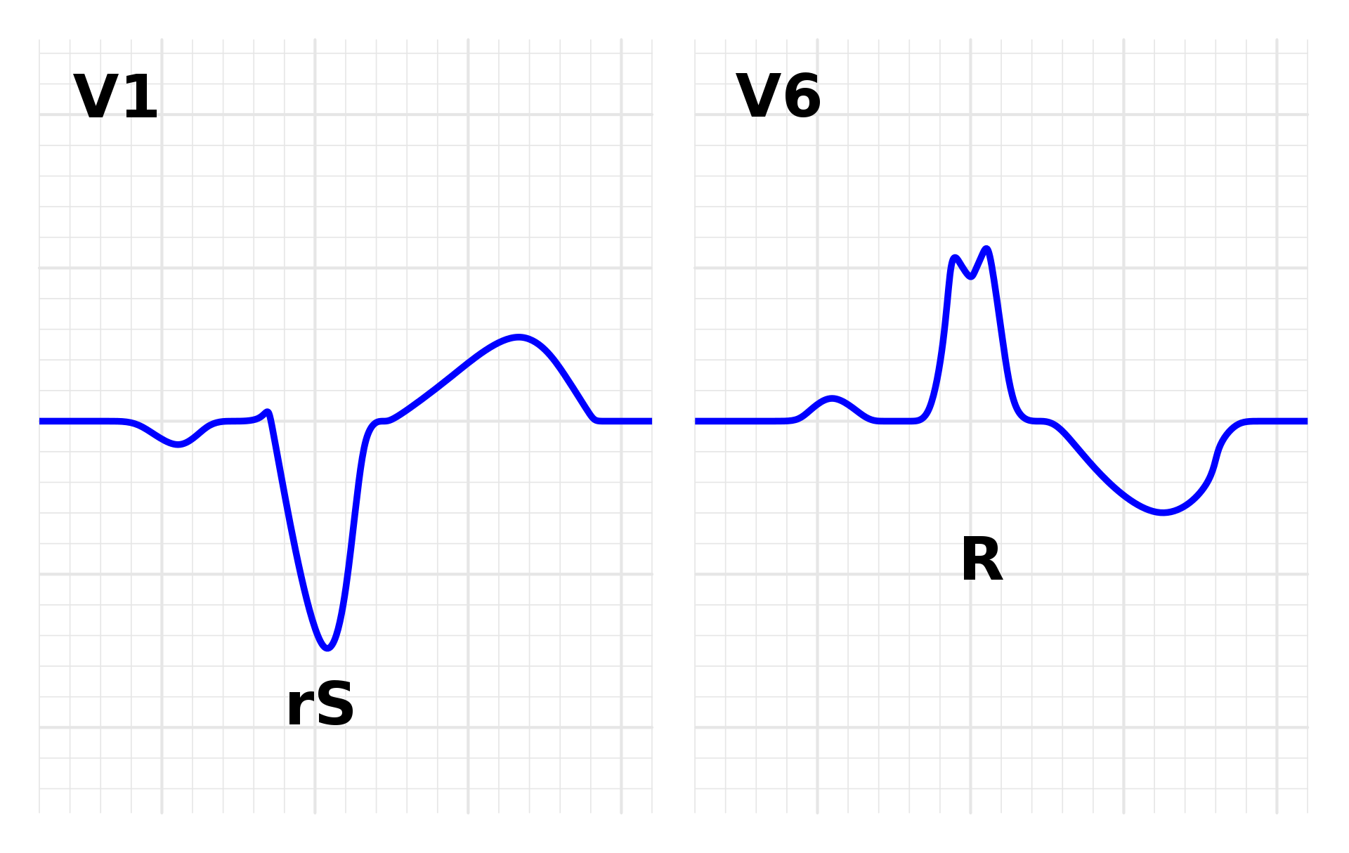 Bundle Branch Blocks