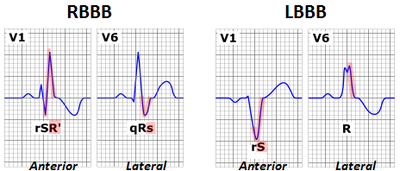 Bundle Branch Blocks