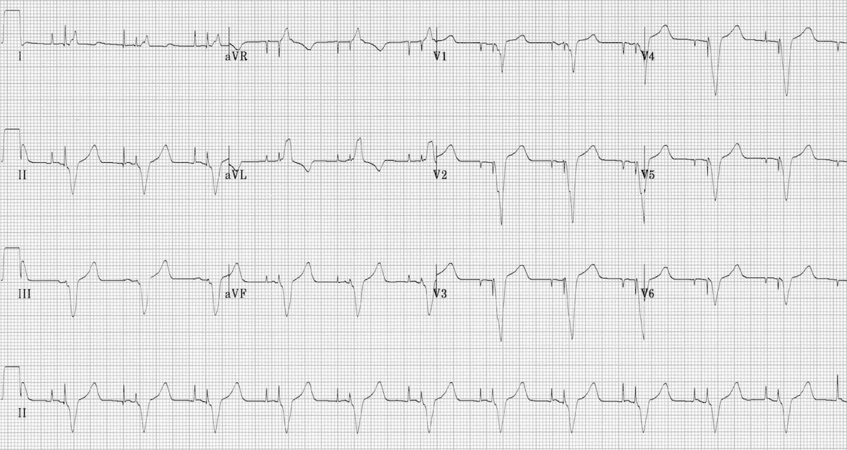 Pacemaker، - Dual pacing