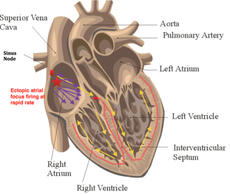 Ectopic Atrial Tachycardia