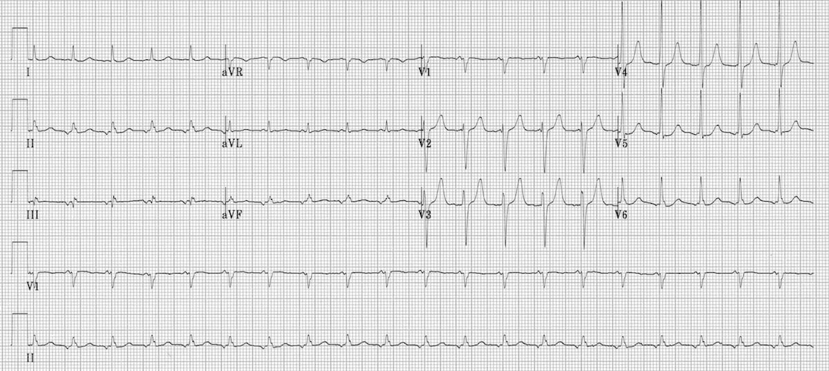 Ectopic Atrial Tachycardia