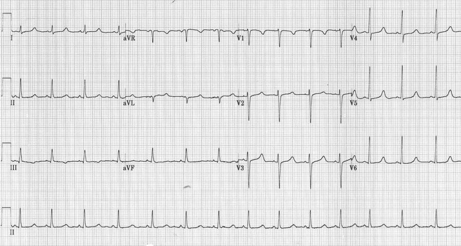 Hypocalcemia