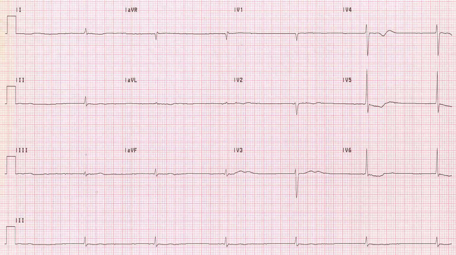 Junctional escape rhythm