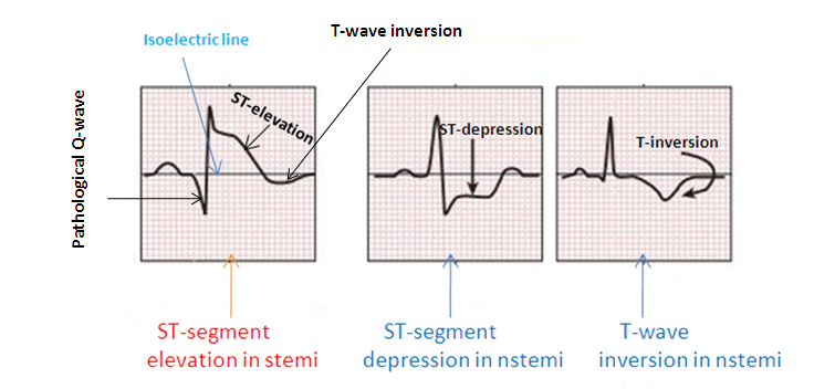 Myocardial Infarction - NSTEMI