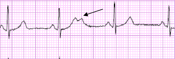 Premature atrial contraction (PAC)