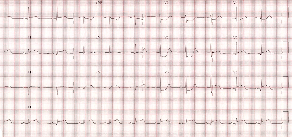 Posterior STEMI