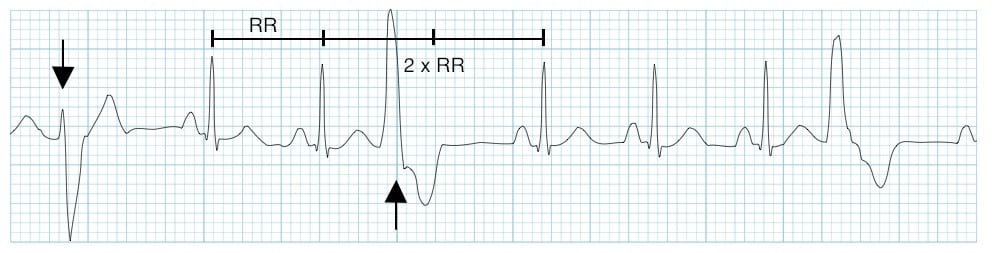 Premature Ventricular contraction (PVC)