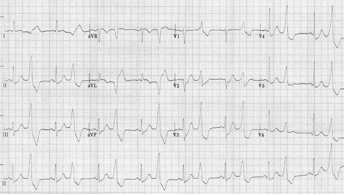 Premature Ventricular contraction (PVC)