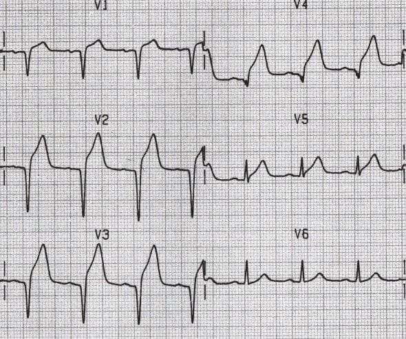 Q wave Infarction