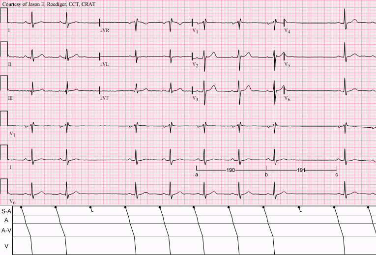 SA block Sinus arrests and SA Exit Blocks