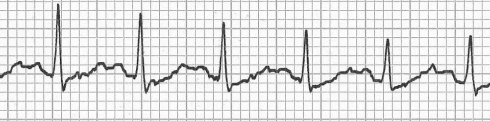 Sinus tachycardia