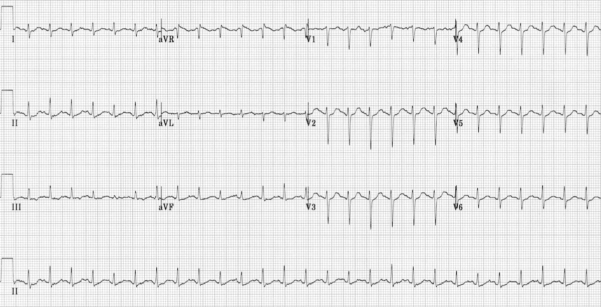 Sinus tachycardia