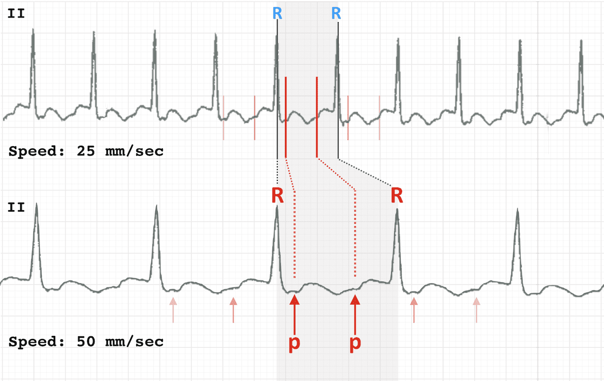 ECG parts Speed