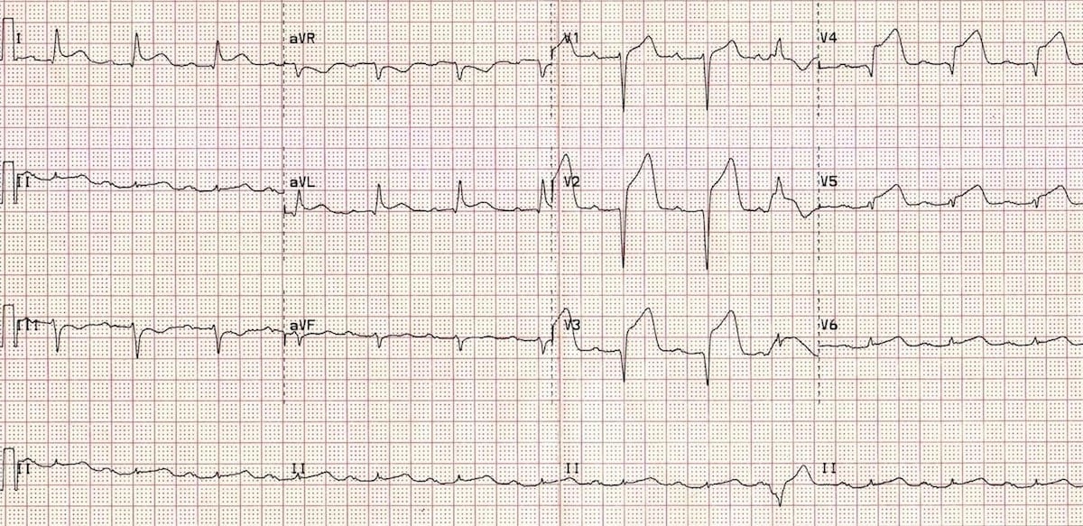 Myocardial Infarction STEMI