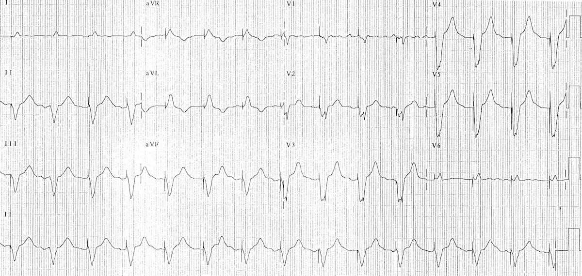 Pacemaker، - Ventricular pacing