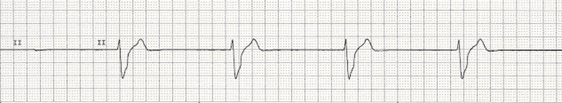 Ventricular escape rhythm