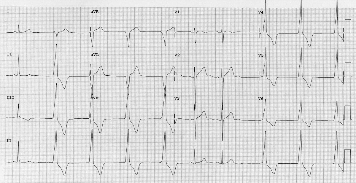 Ventricular escape rhythm