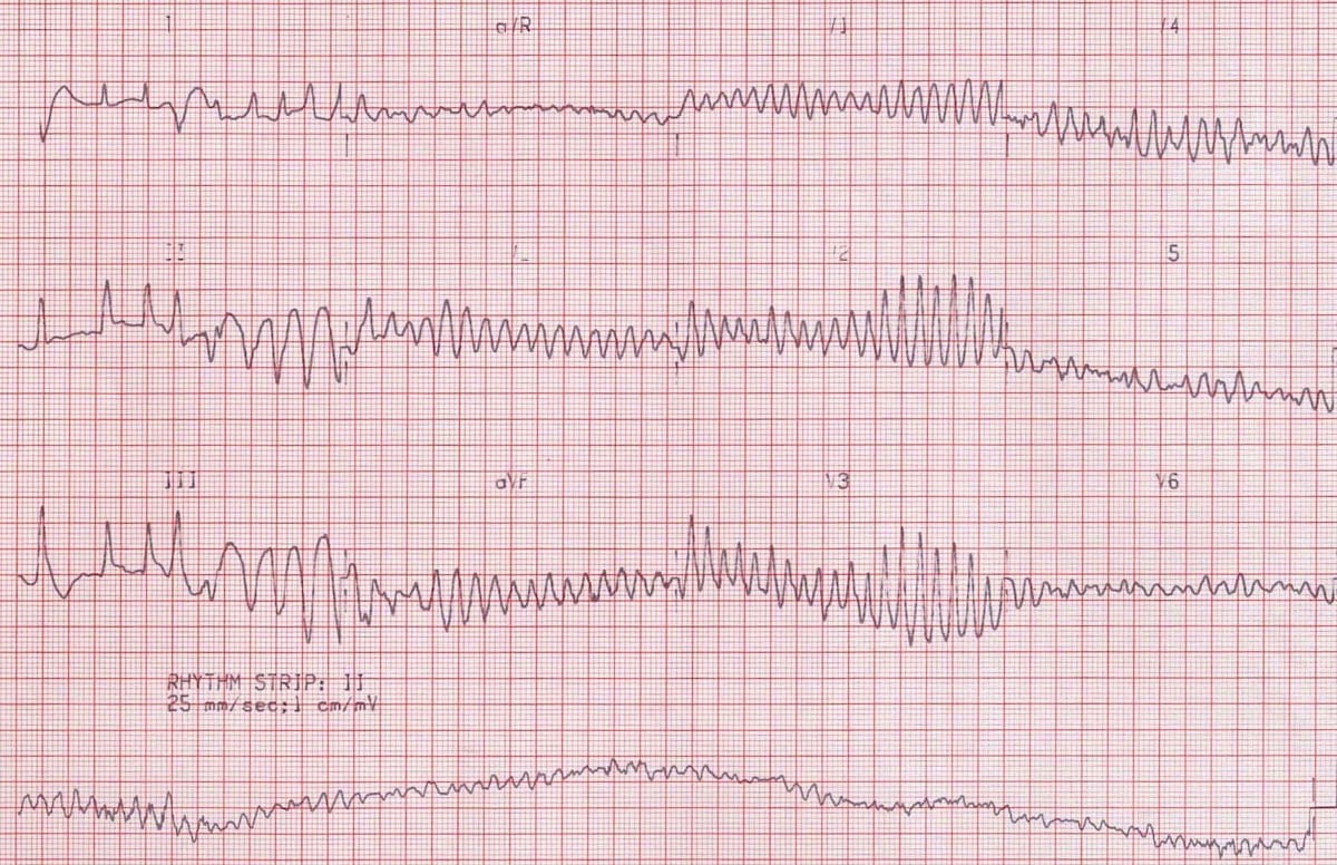 Ventricular Fibrillation