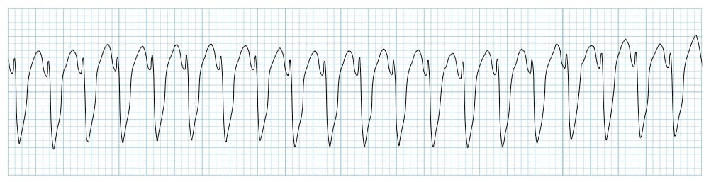 Ventricular Tachycardia