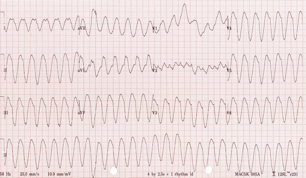 Ventricular Tachycardia