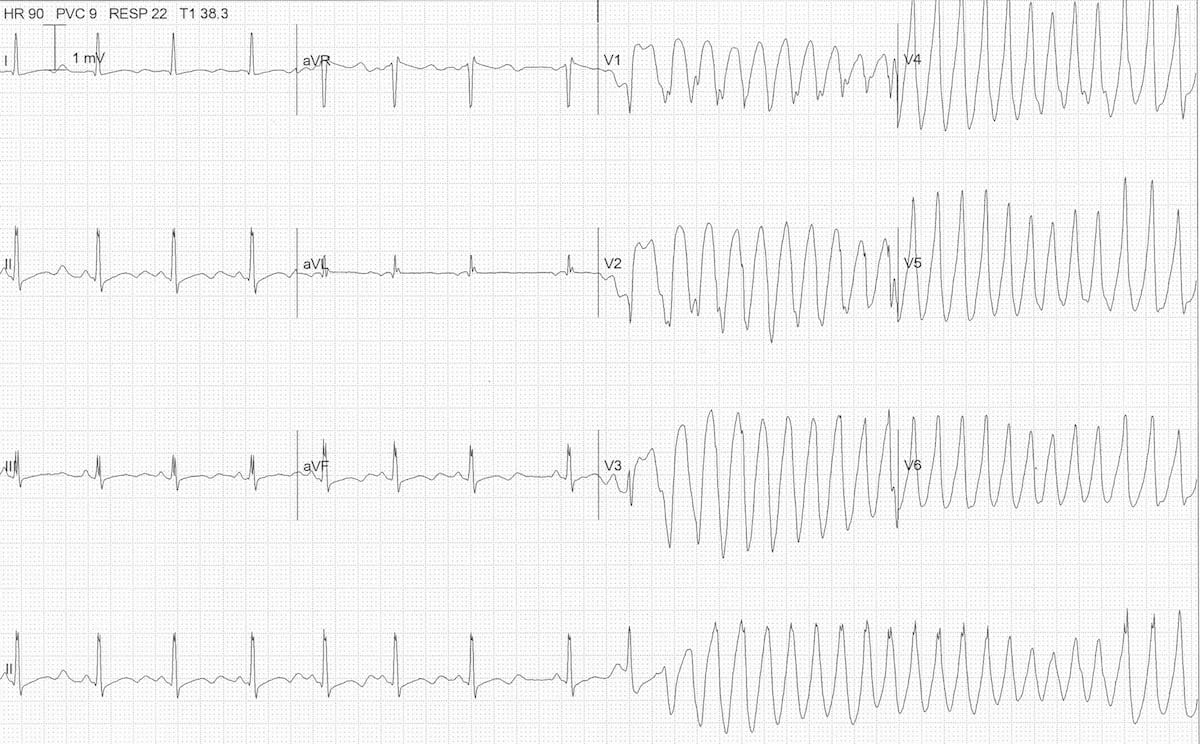 Ventricular Tachycardia